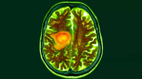 The dangers of glioblastomas