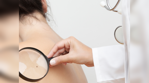 Melanoma diagnosis