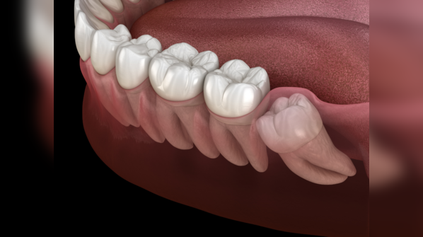 The connection between wisdom teeth and wisdom: