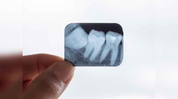 Irritation in the gums