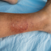 Injured his leg on a treadmill