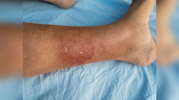 Injured his leg on a treadmill