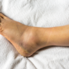 Infection and treadmill injury