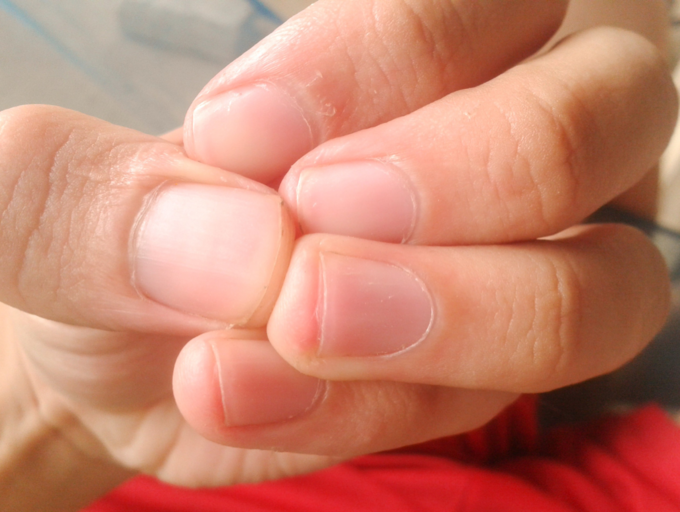 High Cholesterol Symptoms: High cholesterol signs in fingers and toes