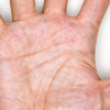 Yellow cholesterol deposits on palm: 