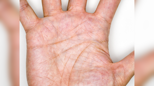 Yellow cholesterol deposits on palm: