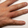 Painful finger and toes: 