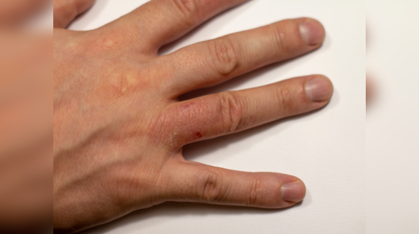 Painful finger and toes: