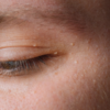 Yellow and orange deposits on eyes: 