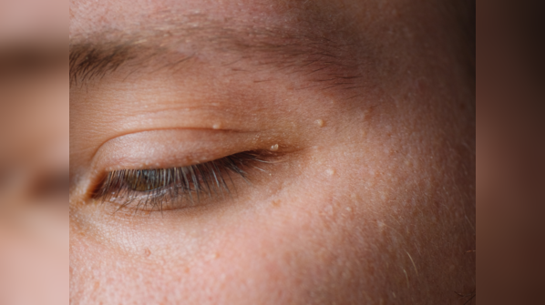 Yellow and orange deposits on eyes: