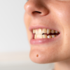 Loss of teeth