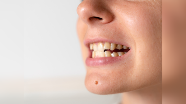 Loss of teeth