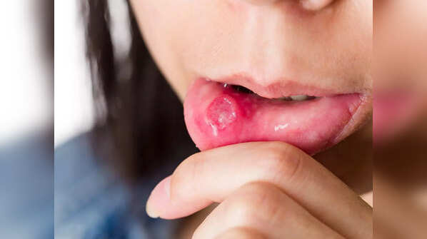 But STIs can transmit through non-penetrative sex too