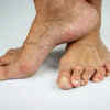 Common symptoms of RA to note