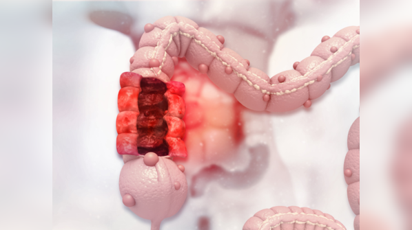 Rising cases of colon cancer: 