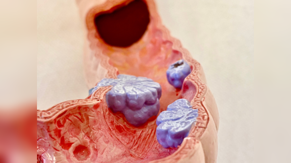 Inflammatory Bowel Disease (IBD): 
