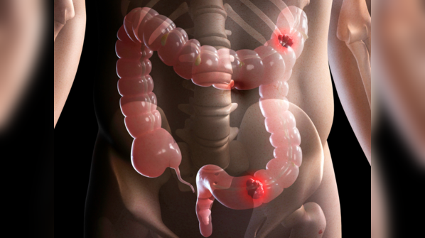 Risk of colon cancer