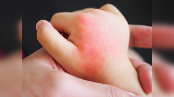 Possible cyst diagnosis in the 3-year-old's hand