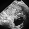 ​​Fallopian Tube Rupture​