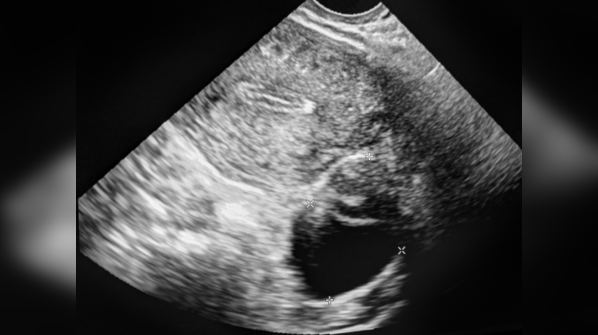 Fallopian Tube Rupture