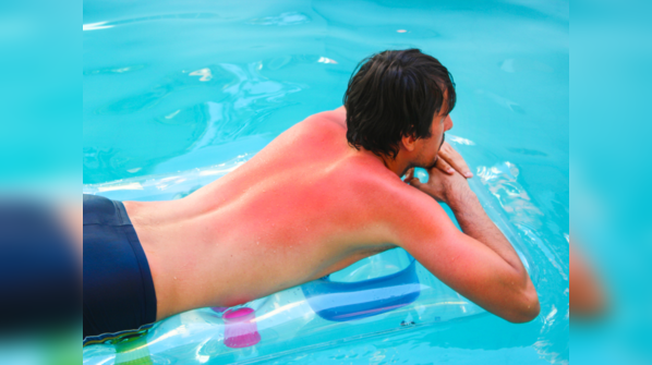 Avoid sunburns