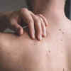​ABCDE guide of identifying melanoma​