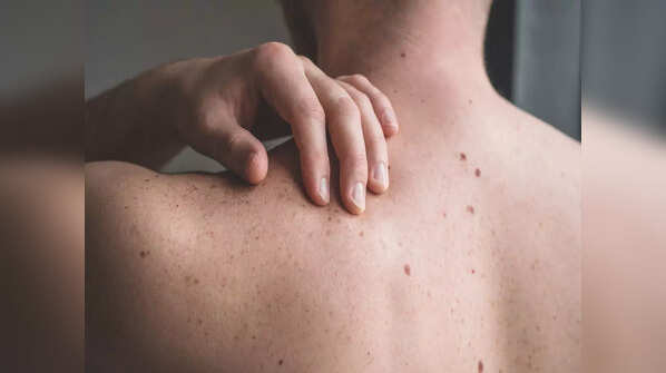 ABCDE guide of identifying melanoma