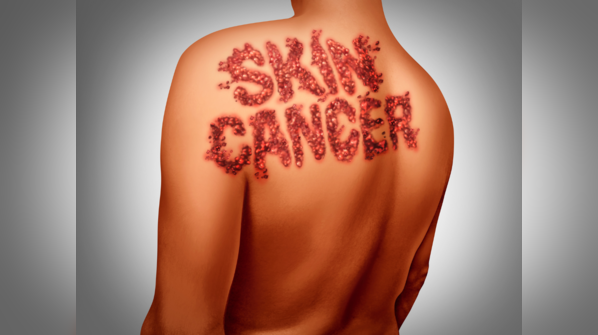 Men at higher risk of skin cancer. Why?