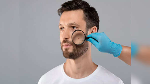 What makes men more vulnerable to melanoma?