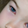 ​Pink eye symptom is seen in kids these days​