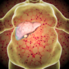 ​​Who is at risk of NAFLD?​