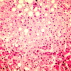 ​​Symptoms of alcoholic fatty liver disease include:​