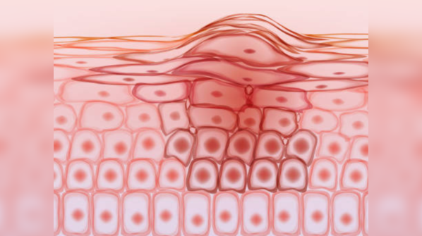 Growing the good skin surgically