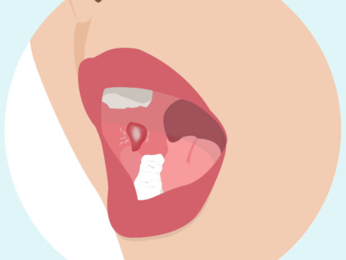 Oral cancer: Specific areas in your mouth where cancer can begin (along with symptoms)
