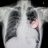 ​​How can irregular heartbeat impact health?​
