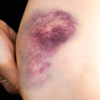 ​Skin discoloration​
