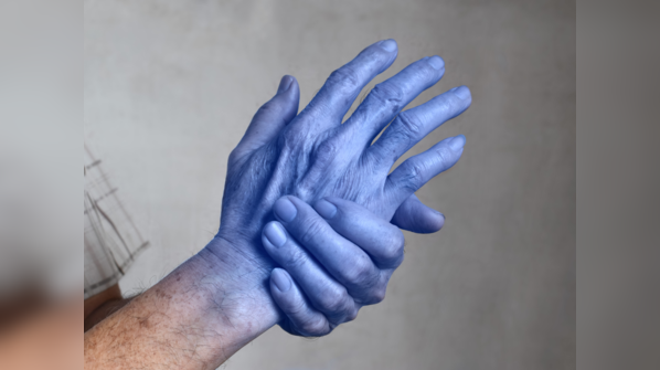 Cold hands and feet