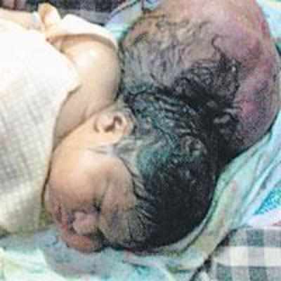 Baby born with two heads