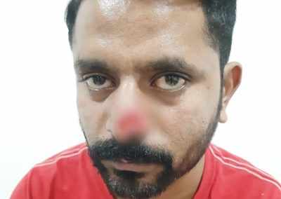 Hyderabad: Man bites friend's nose during clash after drinks