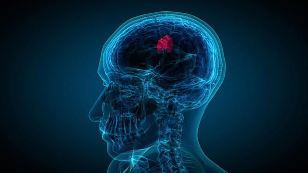 World Brain Tumour Day: Can your lifestyle really influence brain health and tumour risk?