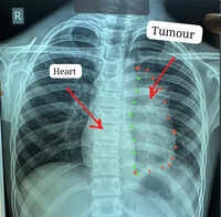 11-year-old&rsquo;s rare cancer removed from heart in Raipur, Chhattisgarh's biggest hosp claims world first
