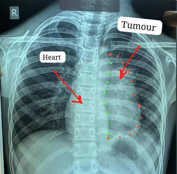 11-year-old’s rare cancer removed from heart in Raipur, Chhattisgarh's biggest hosp claims world first