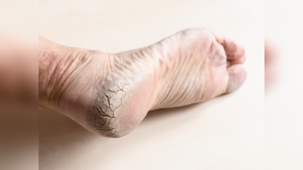 ​Skin thickness: A telltale sign of Diabetes