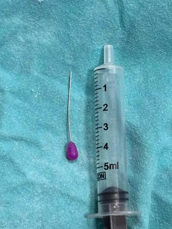 GMCH doctors remove inhaled metal pin from 18-year-old’s lower respiratory system