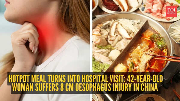 Hotpot meal turns into hospital visit: 42-year-old woman suffers 8 cm oesophagus injury in China
