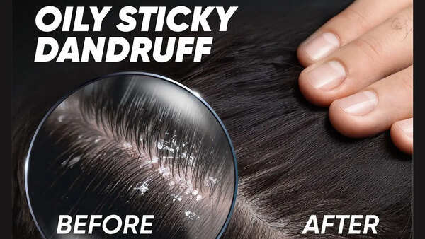 What Makes an Anti-Dandruff Shampoo Effective? 5 Science-Backed Things to Look For