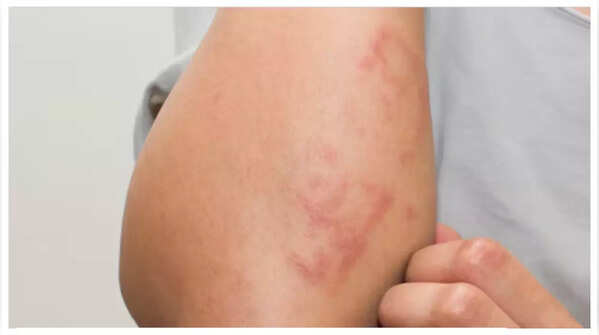Skin changes around joints