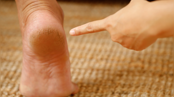 Cracked heels