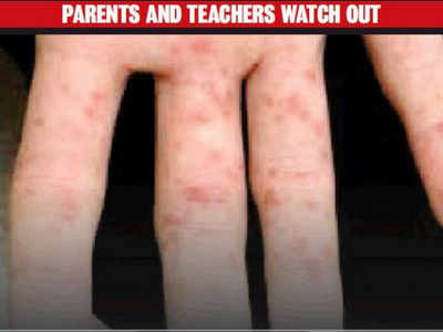 Rise in hand-foot-and-mouth disease has parents worried
