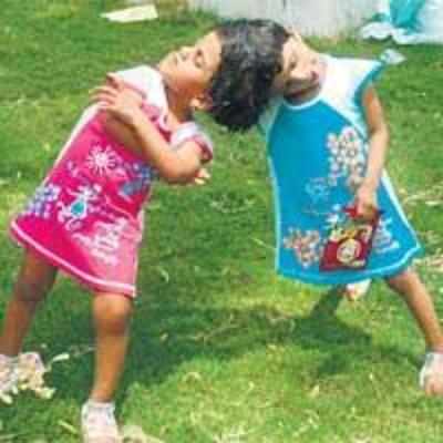 Andhra nod for surgery to separate conjoined twins